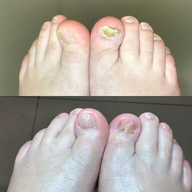 Expérience dans l'utilisation de Barnabas à la crème prometteuse d'Israël, photo avant et après