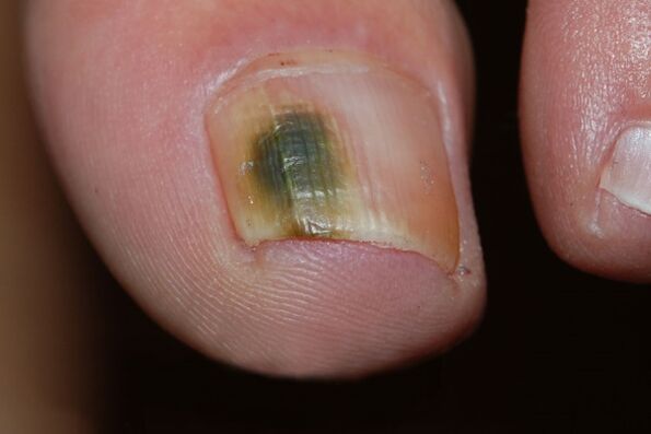 Type de moisissure de champignon d'ongle