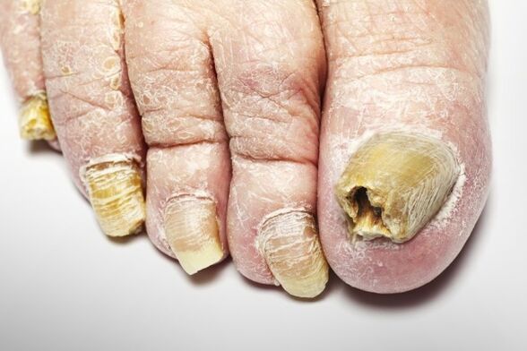 Version globale du champignon des ongles
