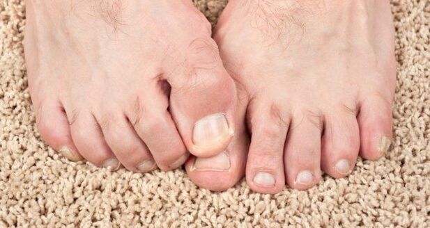 Symptômes des champignons de l'ongle