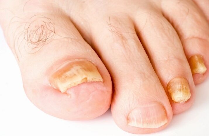 Le champignon sur le pouce de la jambe