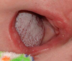 Localisation de la maladie avec un champignon