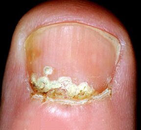 Symptômes et signes de la maladie