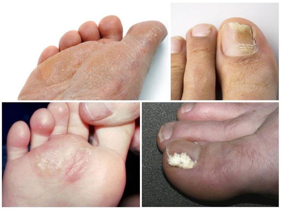 Le stade initial du pied d'athlète