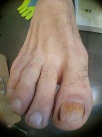 Mycose des ongles sur le gros orteil