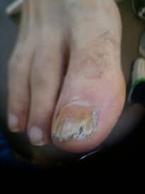 Photo d'un champignon avancé de l'ongle du pied