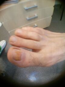 Stade initial de la mycose des ongles sur le gros orteil