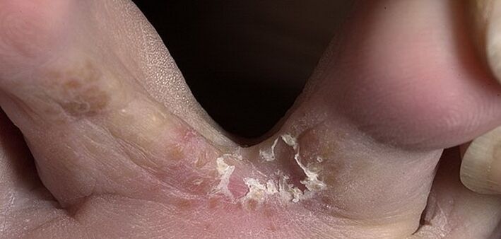 Champignon entre les orteils