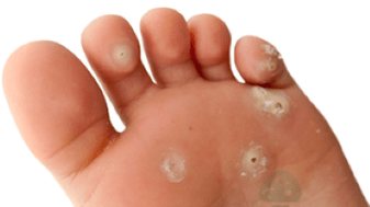 deuxième stade d'une infection fongique