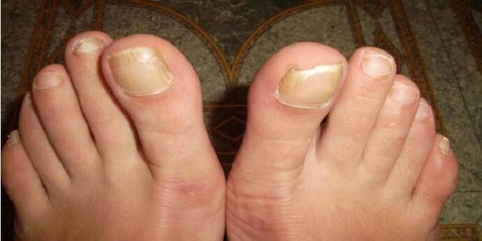 À quoi ressemble la mycose des ongles des pieds 