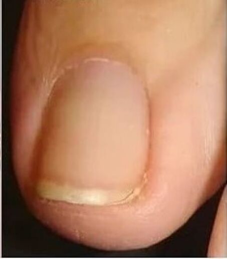 Ongle après traitement fongique au laser