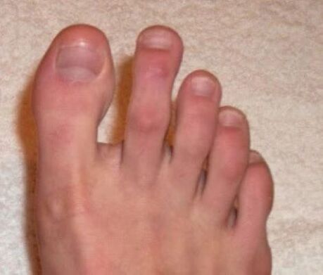 Ongles après traitement au laser contre les champignons