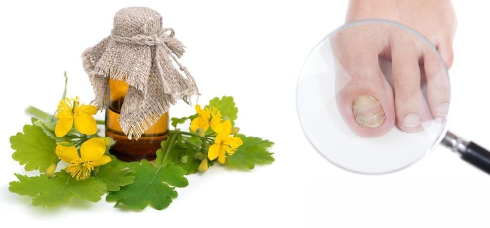 Chélidoine contre la mycose des ongles des pieds