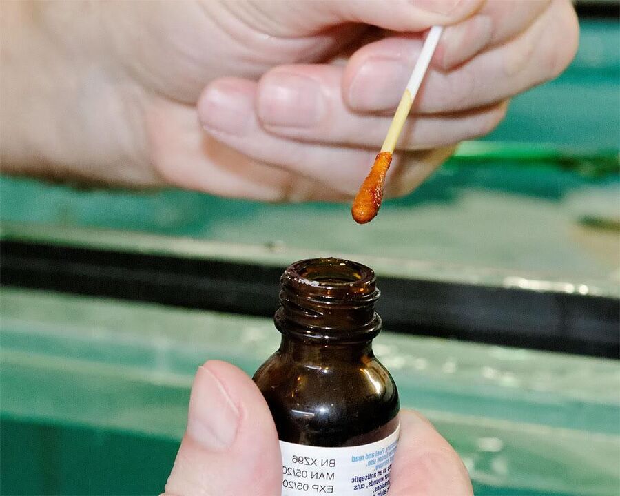 L'application d'un mélange d'iode et de jus de chélidoine sur les ongles des pieds élimine le champignon